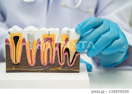 Dentist holding dental implant, artificial tooth roots into jaw, root canal of dental treatment, gum disease, teeth model for dentist. 138959209