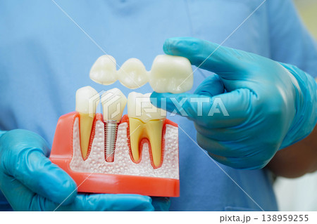 Doctor hold dental implant, artificial tooth roots into jaw, root canal of dental treatment, gum disease, teeth model for dentist studying about dentistry. 138959255