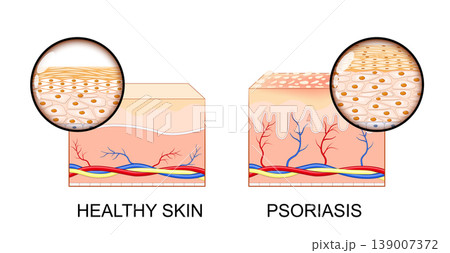 Psoriasis. Healthy Skin and Autoimmune Skin Condition 139007372
