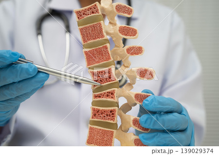 Doctor holding osteoporosis in back bone model for treatment medical. 139029374