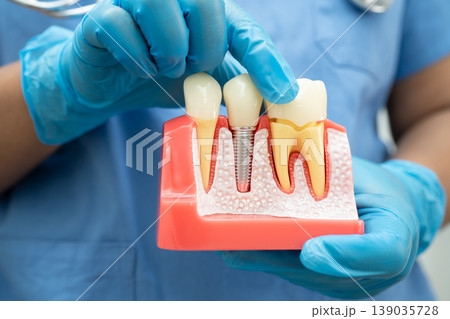 Dentist holding dental implant, artificial tooth roots into jaw, root canal of dental treatment, gum disease, teeth model for dentist. 139035728