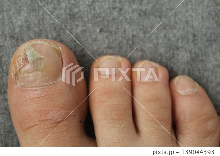 Damaged toenail plate close-up. Nail and skin diseases fungus Damaged toenail plate close-up. Nail and skin diseases fungus 139044393