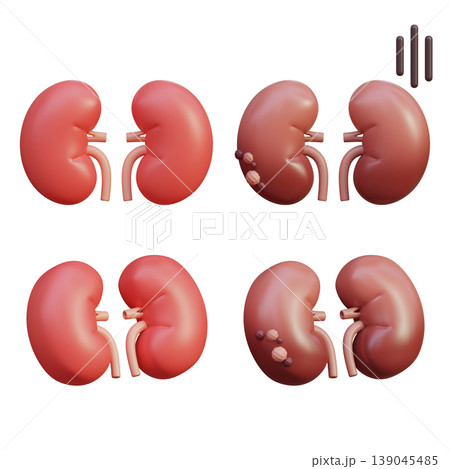 Healthy Kidney and Sick Kidney 3D Illustration Healthy Kidney and Sick Kidney 3D Illustration 139045485