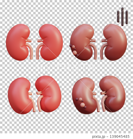 Healthy Kidney and Sick Kidney 3D Illustration Healthy Kidney and Sick Kidney 3D Illustration 139045485