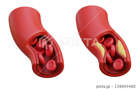 Healthy Blood Vessel and Unhealthy Blood Vessel 3D Illustration 139045488