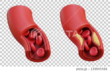 Healthy Blood Vessel and Unhealthy Blood Vessel 3D Illustration 139045488