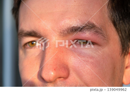 Upper eyelid swelling, allergy to bee sting, risk of anaphylaxis, pain, redness, local infection, possible causes: injury, conjunctivitis, abscess, urgent therapy. Upper eyelid swelling, allergy to bee sting, risk of anaphylaxis, pain, redness, local infection, possible causes: injury, conjunctivitis, abscess, urgent therapy. 139049962