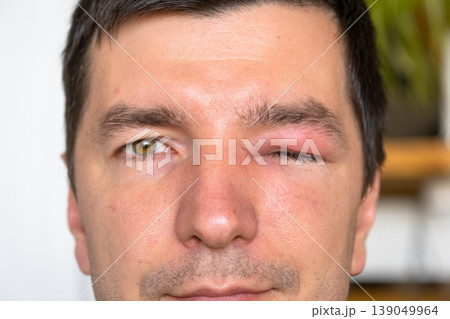 Swollen eyelid after insect (bee) sting, allergy, severe redness, pain and risk of serious effects, possible causes include trauma, conjunctivitis, infection. 139049964