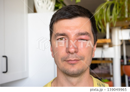 Puffy eye from bee sting, allergy, local swelling, redness, risk of infection or conjunctivitis, need urgent treatment, possible complications for eyesight. Puffy eye from bee sting, allergy, local swelling, redness, risk of infection or conjunctivitis, need urgent treatment, possible complications for eyesight. 139049965