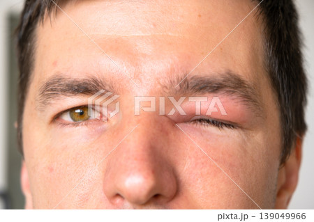 Unilateral eyelid swelling after bee sting, allergic reaction, pain, redness, risk factors: infection, injury, foreign body, conjunctivitis, abscess, urgent care. 139049966