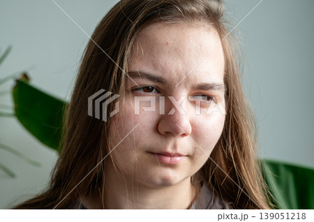 Teenager girl with acne skin. High quality photo Teenager girl with acne skin. High quality photo 139051218