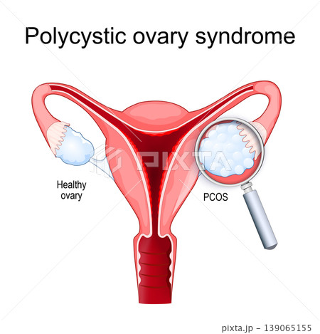 Polycystic ovary syndrome. Healthy ovary, PCOS, uterus and Magnifying glass Polycystic ovary syndrome. Healthy ovary, PCOS, uterus and Magnifying glass 139065155