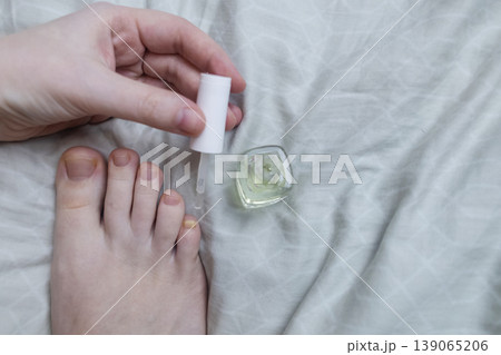 A woman in pajamas sitting on a bed and applying antifungal nail polish to treat onychomycosis. Home treatment of fungal infection, yellow nails, and medical pedicure for healthy feet. 139065206
