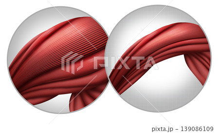 Muscle Atrophy Muscle Atrophy 139086109