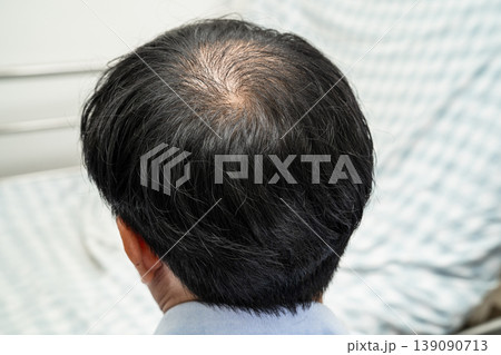 Bald in the middle head and begin no loss hair glabrous of mature Asian business smart active office man. Bald in the middle head and begin no loss hair glabrous of mature Asian business smart active office man. 139090713