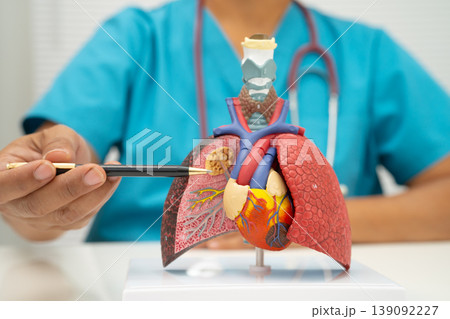 Pneumonia, lung cancer, Asian doctor holding human model. 139092227