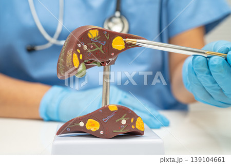 Cirrhosis, Liver cancer, fatty liver, Asian doctor with liver human model. Cirrhosis, Liver cancer, fatty liver, Asian doctor with liver human model. 139104661