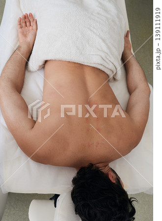Acupuncture for a back of a adult man in a Chinese clinic. View from above Acupuncture for a back of a adult man in a Chinese clinic. View from above 139111919