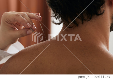 Reflexologist's hand with an acupuncture needle close-up while insert needle into a man's shoulder for treatment Reflexologist's hand with an acupuncture needle close-up while insert needle into a man's shoulder for treatment 139111925