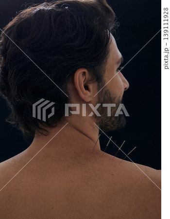 Acupuncture, reflexology. Close-up view from male patient back with acupuncture needles in his shoulder with pain, over black background Acupuncture, reflexology. Close-up view from male patient back with acupuncture needles in his shoulder with pain, over black background 139111928