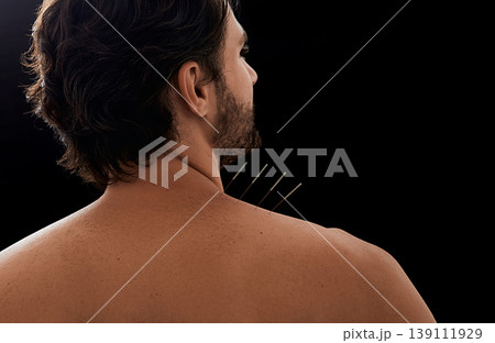 Acupuncture, reflexology. Close-up view from male patient back with acupuncture needles in his shoulder with pain, over black background Acupuncture, reflexology. Close-up view from male patient back with acupuncture needles in his shoulder with pain, over black background 139111929