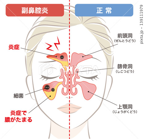 副鼻腔炎の鼻腔と正常な鼻腔 副鼻腔炎の鼻腔と正常な鼻腔 139111979