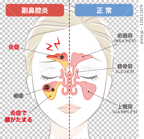副鼻腔炎の鼻腔と正常な鼻腔 副鼻腔炎の鼻腔と正常な鼻腔 139111979
