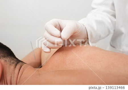 Acupuncturist hand with acupuncture needle. Acupuncture treatment of chronic male back pain 139113466