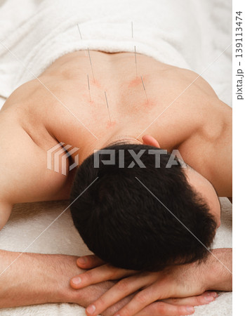 Man with acupuncture needles in his back is receiving treatment in a traditional Chinese medicine clinic. Needles close-up 139113474