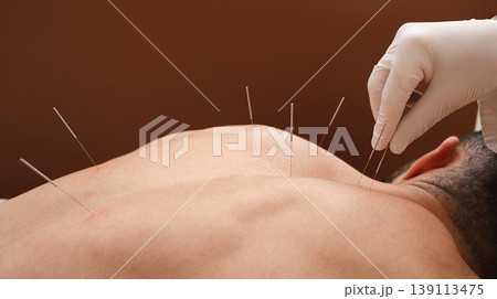 Close-up needle in the back of man during acupuncture procedure on a brown background. Acupuncture. Macro Close-up needle in the back of man during acupuncture procedure on a brown background. Acupuncture. Macro 139113475