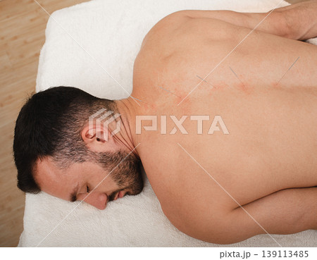 Male during spinal acupuncture procedure. Spinal acupuncture for intervertebral hernias and protrusions Male during spinal acupuncture procedure. Spinal acupuncture for intervertebral hernias and protrusions 139113485