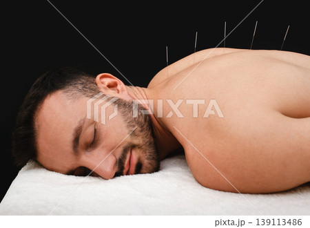 Male during acupuncture procedure. Spinal acupuncture for intervertebral hernias and protrusions. Acupuncture needles close up on black background 139113486