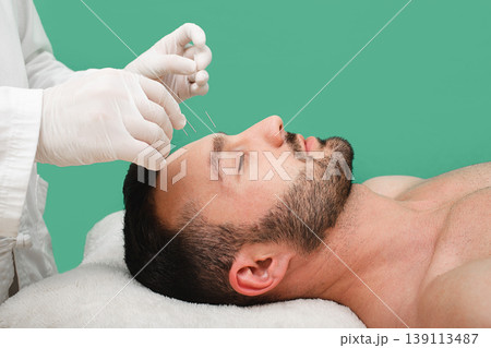 Acupuncturist inserting acupuncture needles into patients skin head. Traditional chinese medicine Acupuncturist inserting acupuncture needles into patients skin head. Traditional chinese medicine 139113487