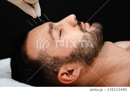 Acupuncture treatment to relieve stress and relax the body man. Closeup acupuncture needles in a man's forehead on a black background. Acupuncture treatment to relieve stress and relax the body man. Closeup acupuncture needles in a man's forehead on a black background. 139113490
