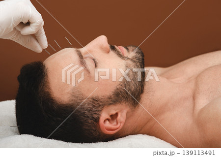 Acupuncture treatment for man headache and migraine. Closeup acupuncture needles in a man's forehead on a brown background 139113491