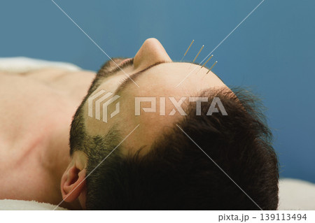 Man received acupuncture treatment in a clinic of ancient Chinese medicine. Acupuncture headache treatment 139113494