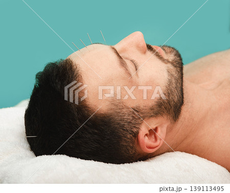 Man has a headache. Acupuncture treatment for migraines. Close-up acupuncture needles in a man's forehead on a blue background. Man has a headache. Acupuncture treatment for migraines. Close-up acupuncture needles in a man's forehead on a blue background. 139113495