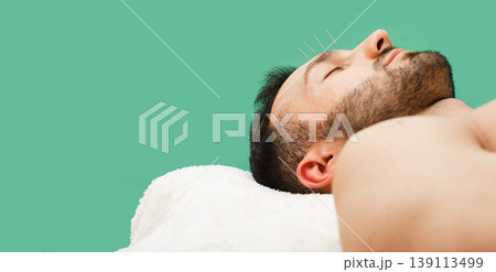 Acupuncture needles for treating a man's headache. Traditional chinese medicine Acupuncture needles for treating a man's headache. Traditional chinese medicine 139113499