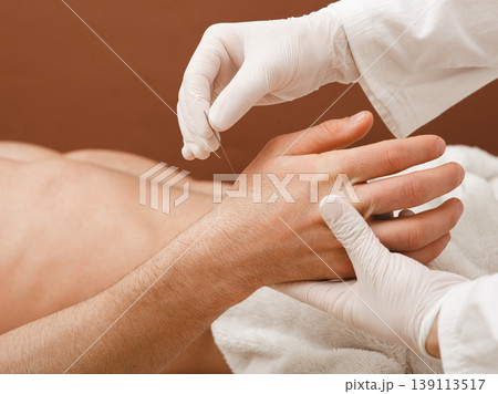 Reflexologist insert an acupuncture needle into a patient's hand. Acupuncture treatment for many diseases. Close-up Reflexologist insert an acupuncture needle into a patient's hand. Acupuncture treatment for many diseases. Close-up 139113517