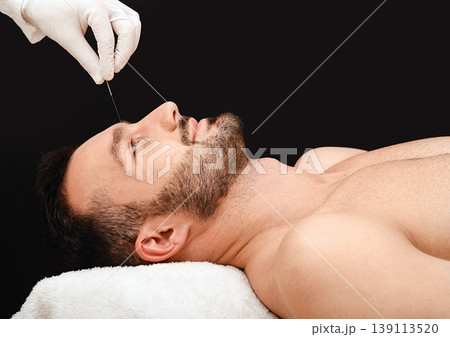 Acupuncture treatment to relieve stress and relax the body man. Acupuncture is a traditional Chinese medicine. Acupuncture needles close-up on a black background 139113520