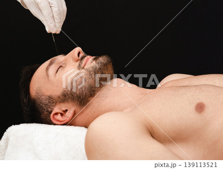 Man enjoys the acupuncture procedure. Acupuncturist doing acupuncture very accurately. Acupuncture needles close-up on a black background Man enjoys the acupuncture procedure. Acupuncturist doing acupuncture very accurately. Acupuncture needles close-up on a black background 139113521