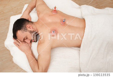 Caucasian man having traditional chinese treatment, acupuncture cups on male back, view from above. Man recovery his health Caucasian man having traditional chinese treatment, acupuncture cups on male back, view from above. Man recovery his health 139113535