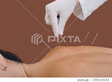 Acupunturist hand with acupuncture needle. Acupuncture treatment of chronic back pain of a woman Acupunturist hand with acupuncture needle. Acupuncture treatment of chronic back pain of a woman 139114143