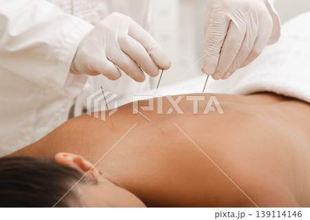 Acupuncturist punctures needle at special points on the back and is very accurate. Acupuncture close up. Traditional Chinese medicine 139114146