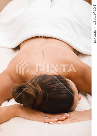 Acupuncture treatment of body. Needles along the spine of a woman in an acupuncture clinic. Acupuncture treatment of body. Needles along the spine of a woman in an acupuncture clinic. 139114151