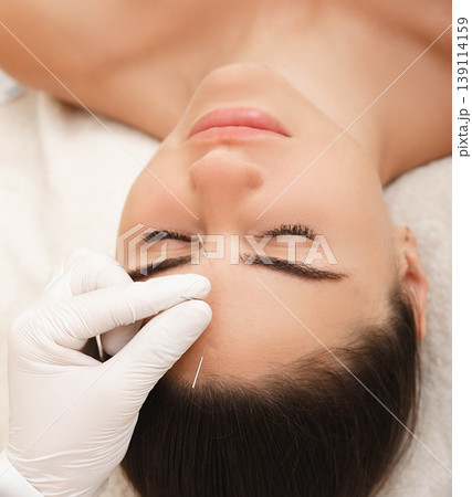 Acupuncture treatment for woman headache and migraine. Certified acupuncturist treats a woman's migraines with needles Acupuncture treatment for woman headache and migraine. Certified acupuncturist treats a woman's migraines with needles 139114159
