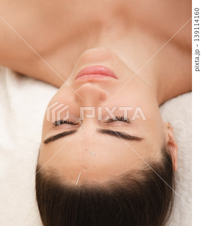 Antistress. Acupuncture of a woman's head helps get rid of migraines. Alternative medicine Antistress. Acupuncture of a woman's head helps get rid of migraines. Alternative medicine 139114160