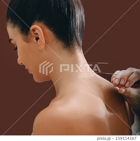 Acupuncture needles in a woman's spine close-up on a brown background. Reflexologist very accurately doing acupuncture. Osteochondrosis treatment Acupuncture needles in a woman's spine close-up on a brown background. Reflexologist very accurately doing acupuncture. Osteochondrosis treatment 139114167