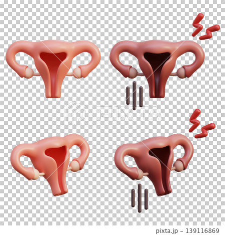 Healthy and Sick Uterus 3D Medical Icon Set Healthy and Sick Uterus 3D Medical Icon Set 139116869