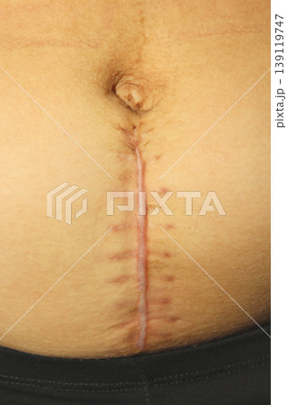 seams after the operation of Caesarian section. Scar from a c-section birth seams after the operation of Caesarian section. Scar from a c-section birth 139119747